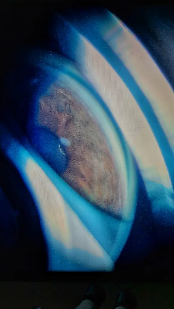 Imagem de gonioscopia mostrando ângulo da câmara anterior em paciente com glaucoma