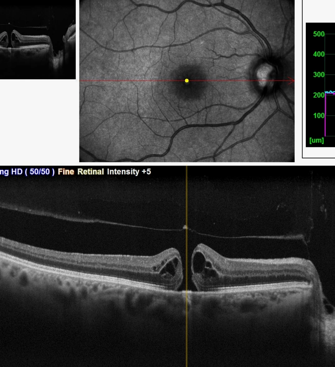Buraco macular visualizado no OCT