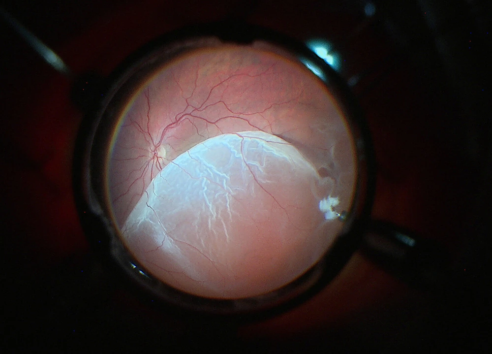 Imagem de descolamento de retina