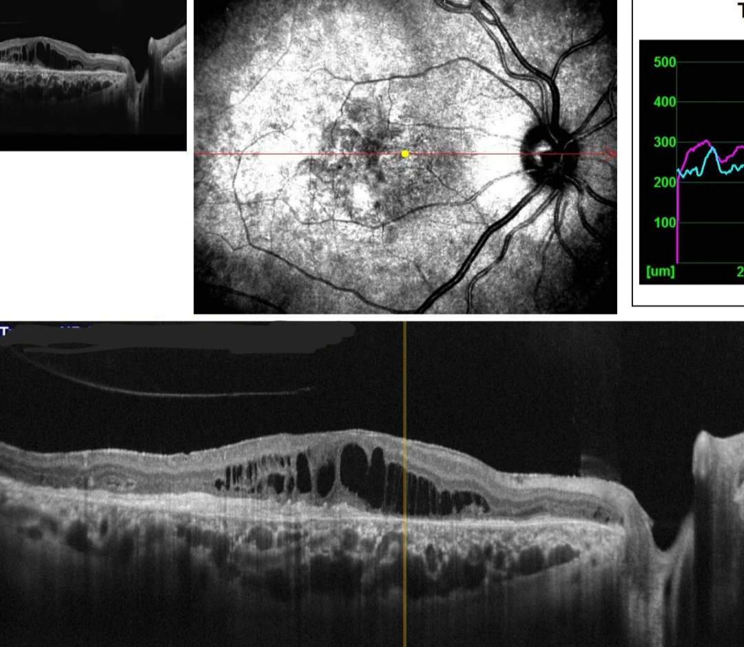 Imagem de Degeneração Macular Relacionada à Idade