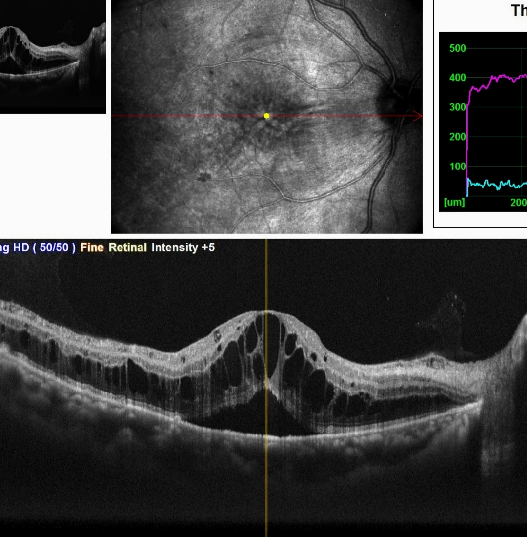 Edema Macular Diabético visualizado no OCT