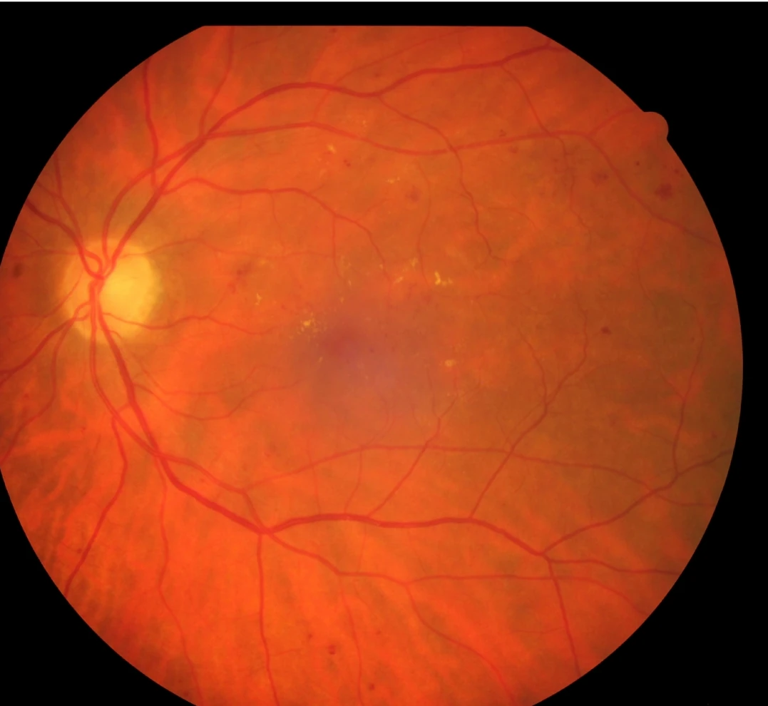 Imagem de retinopatia diabética
