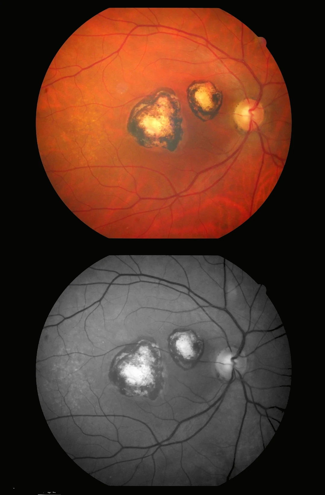 Toxoplasmose ocular ativa e cicatricial